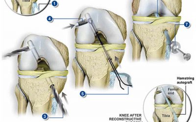 Long term prognosis after an ACL injury