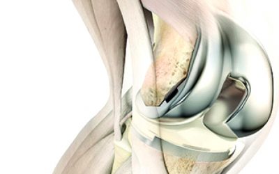 What is a Total Knee Replacement?