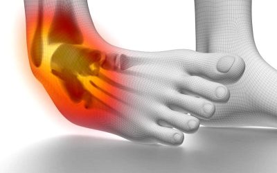 X-ray after an ankle injury?