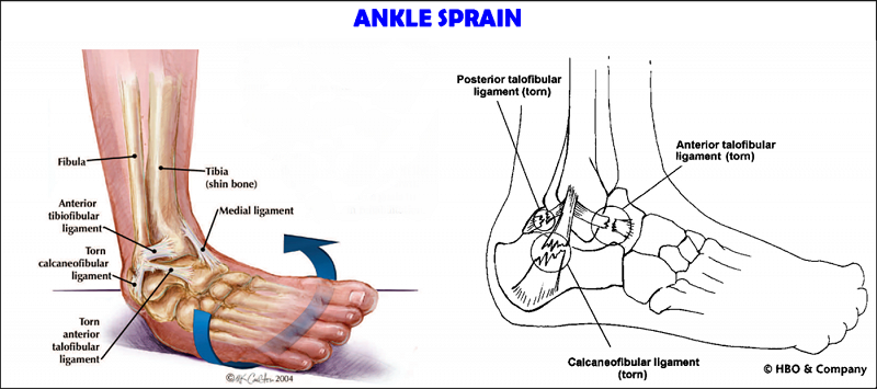 Kinesiotape versus Non-elastic tape for ankles