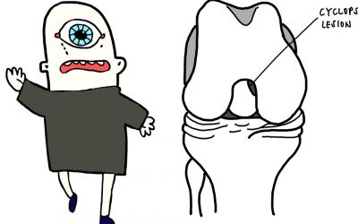 Extension restrictions after ACL/R? Ever considered a Cyclops Lesion?