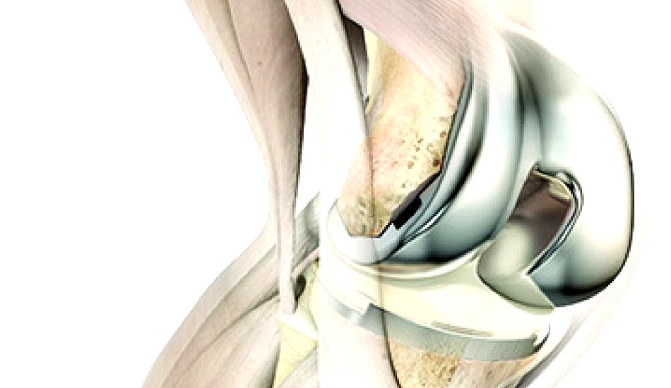 Total Knee Replacement