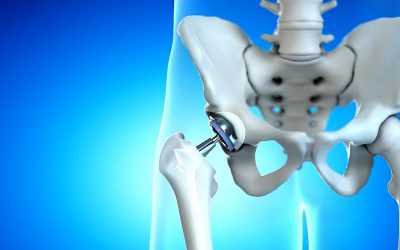 Total Hip Replacement