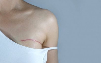 Shoulder pain after mastectomy: WHY and WHAT can I do?