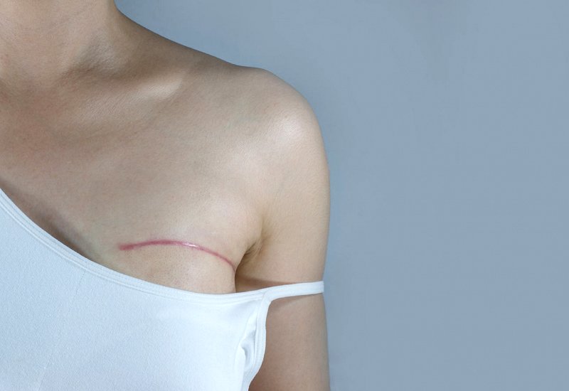 Как выглядит шов после мастэктомии These Inspiring Breast Cancer Tattoos Send a Powerful Message About Strength and