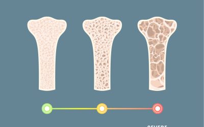 Strong bones, strong you. Manage osteoporosis today!
