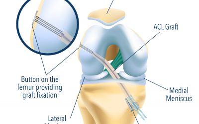 Graft difference after an ACL surgery?